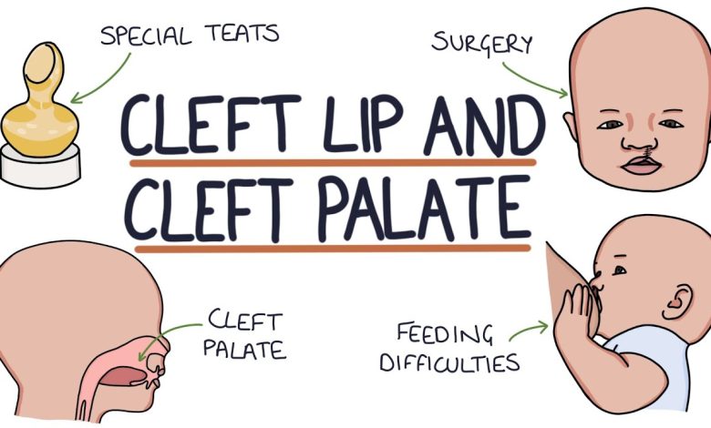 big doctors will do cleft lip palate operations for 120 children in Jhansi uttar pradesh by us